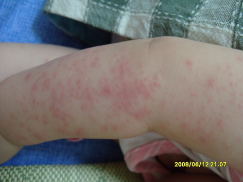 宝宝胳膊湿疹(图片),湿疹症状图片